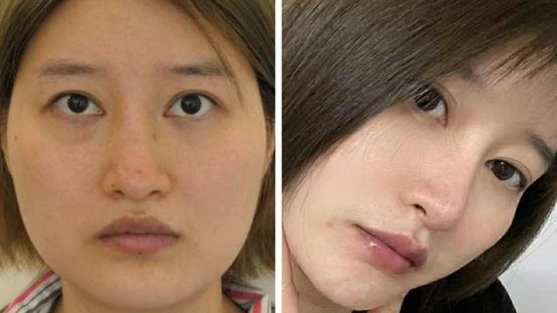 光子嫩肤术后洗脸攻略：哪些细节要注意？**