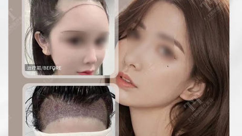 小标题：肉毒素下颌缘提升反弹的原因