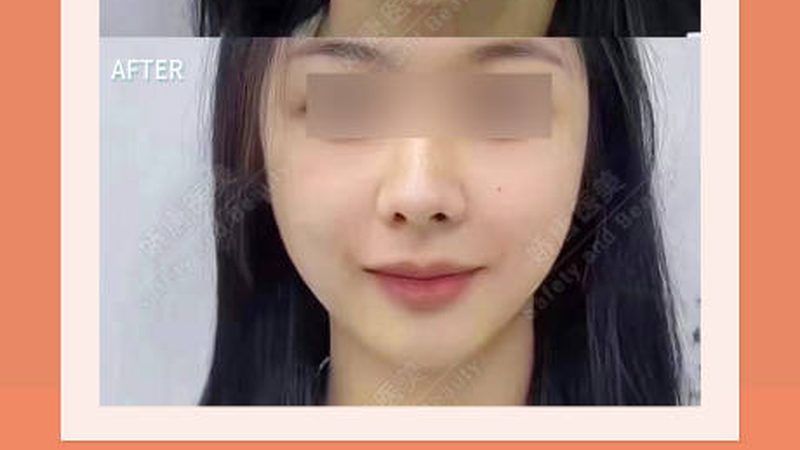 玻尿酸水光针保养，揭秘玻尿酸规格参数的奥秘