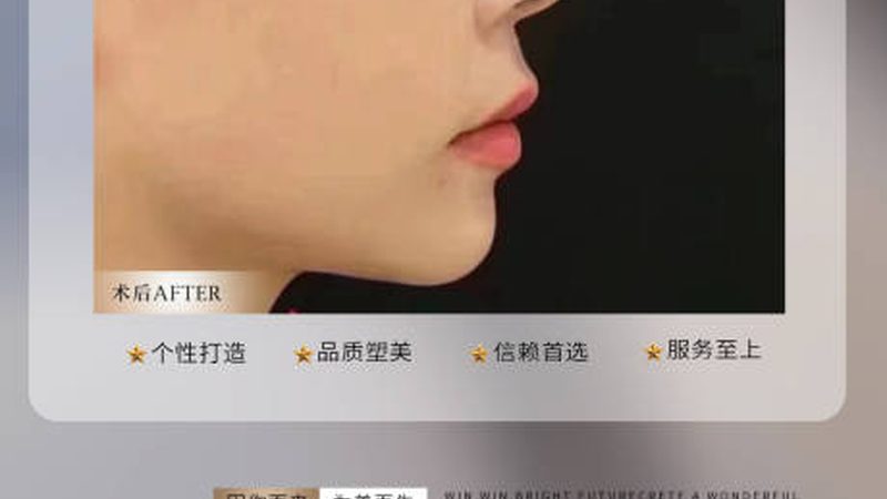 热玛吉代理加盟费背后，藏着哪些行业真相