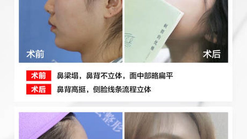 小标题：术后恢复，了解这些才能安心