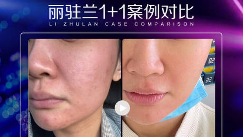 双眼皮手术不是选医生，是选审美匹配度