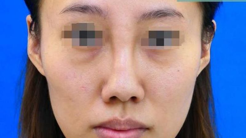 自体脂肪填充：揭秘其优缺点，助你明智选择